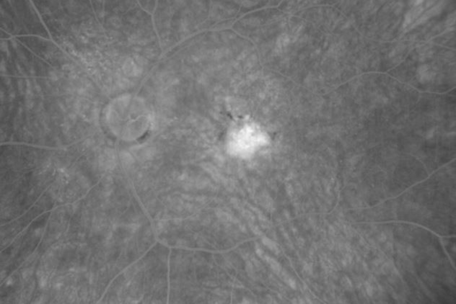 Ocular image of late FA