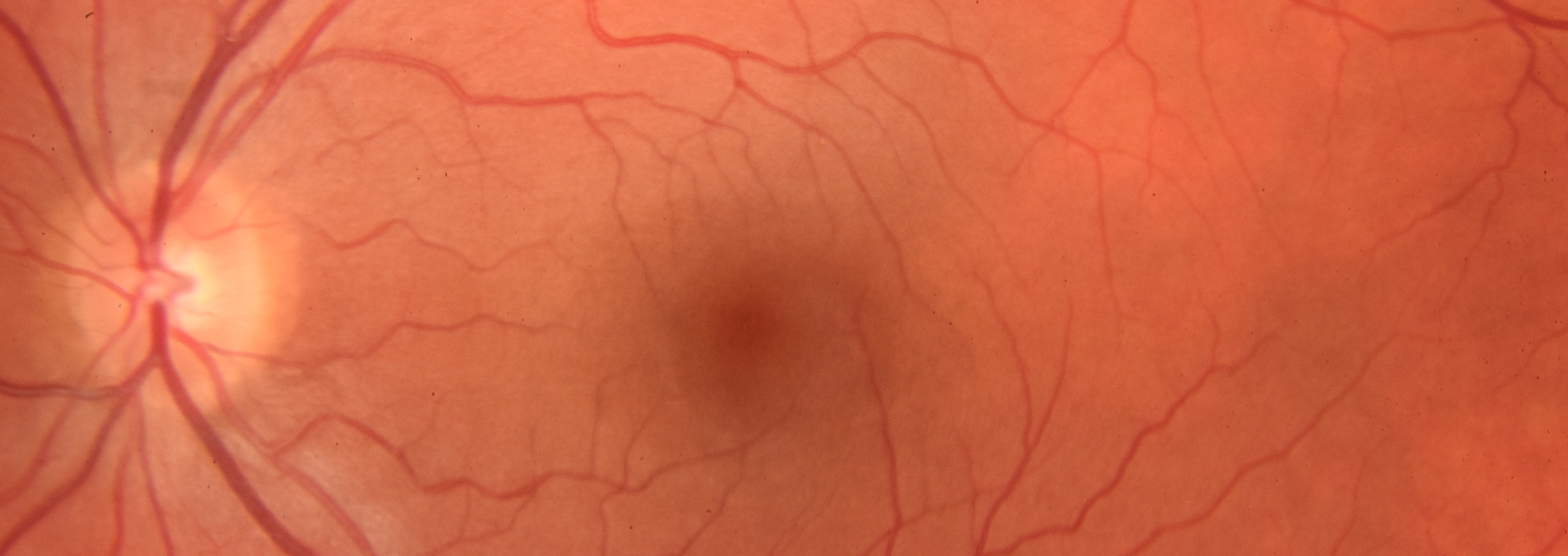 Fundus image of retina
